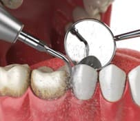 The "Silent Thief" of Smiles: How Tartar Leads to Tooth Loss