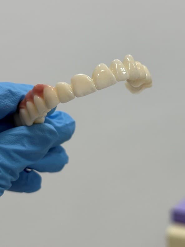 Zirconia vs. The "Old Way": The End of the Black Line at the Gums