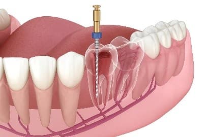 The "Invisible" Danger: Why Saving a Tooth is Better Than Pulling It