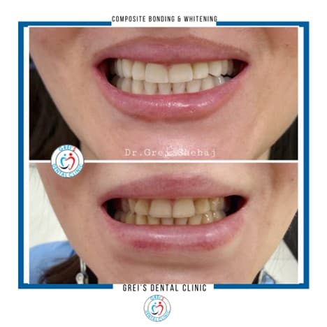 Composite bonding and whitening