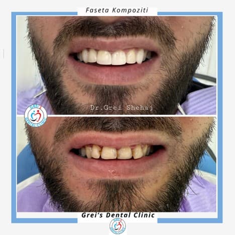 Composite veneers