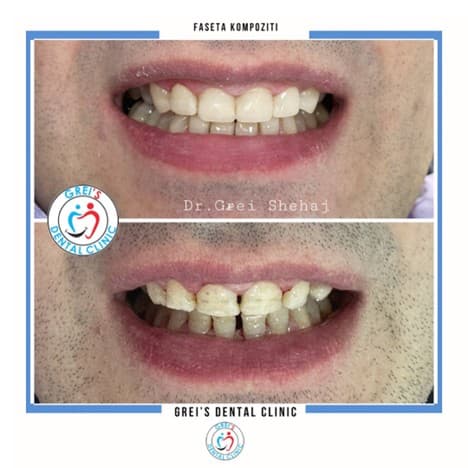 Composite veneers