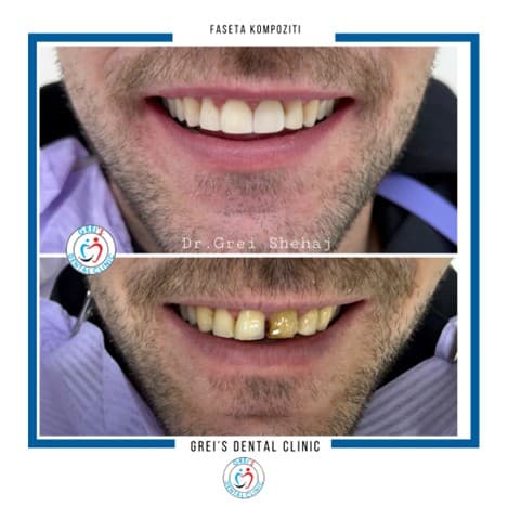 Composite veneers