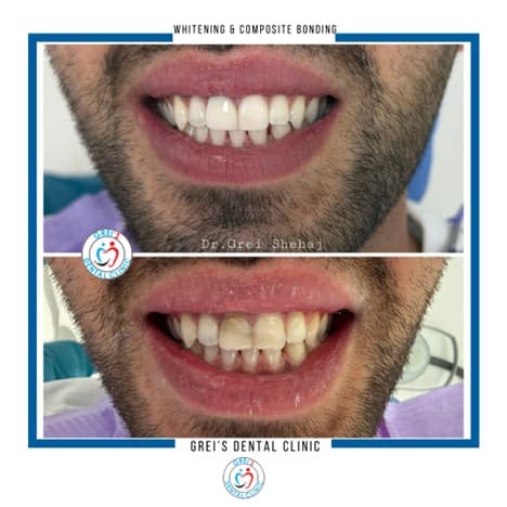 Composite bonding and whitening