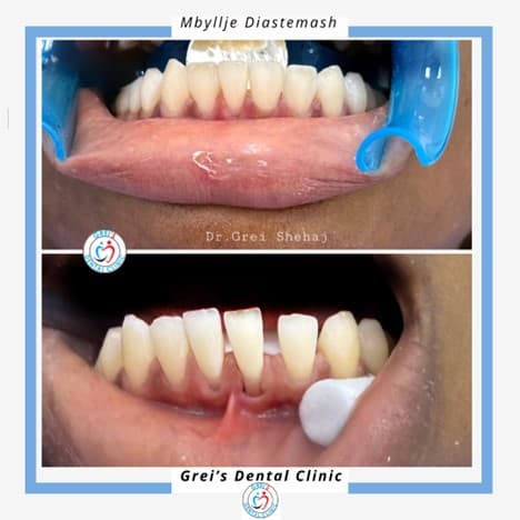 Diastema closure (closing gaps)