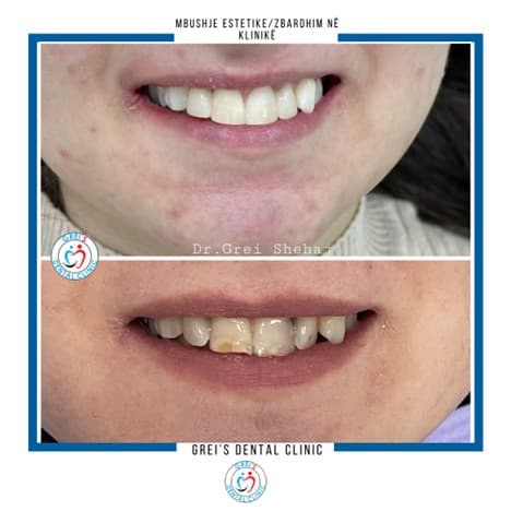Aesthetic filling and in-clinic whitening