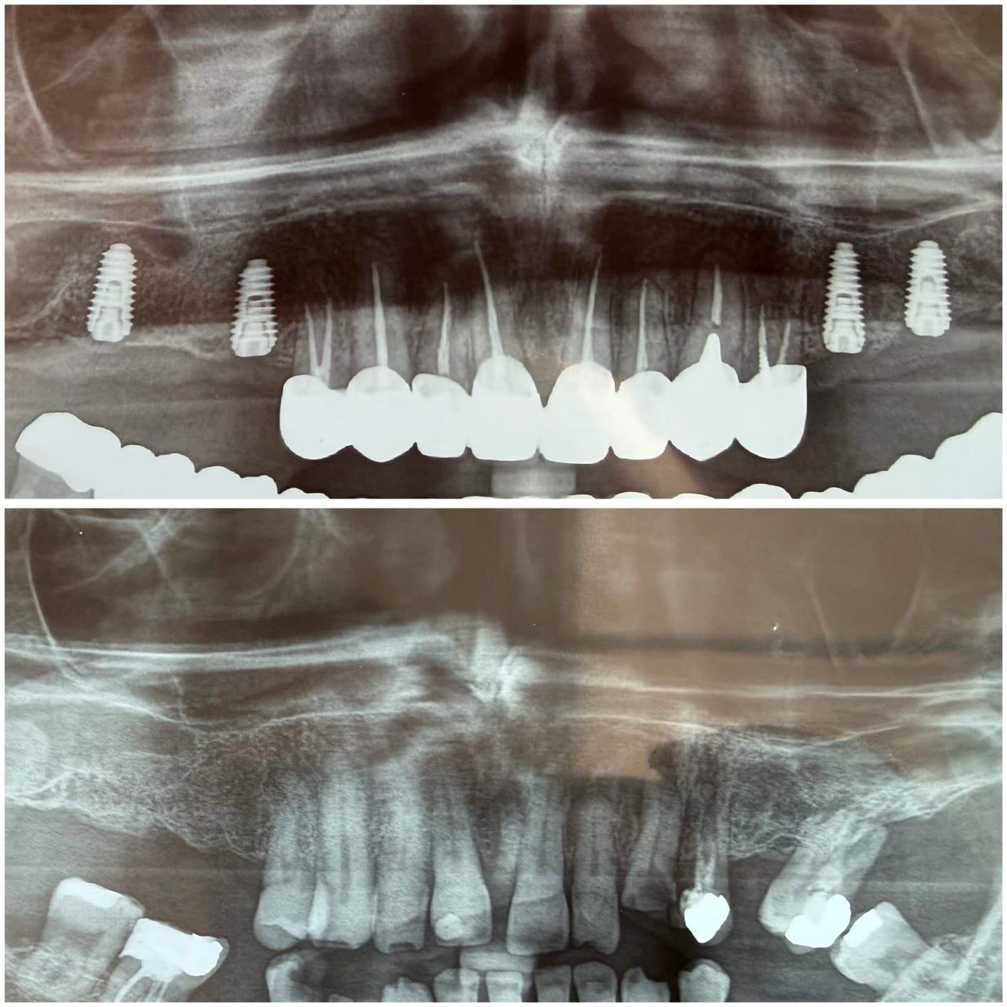 Endodontic root canal therapy