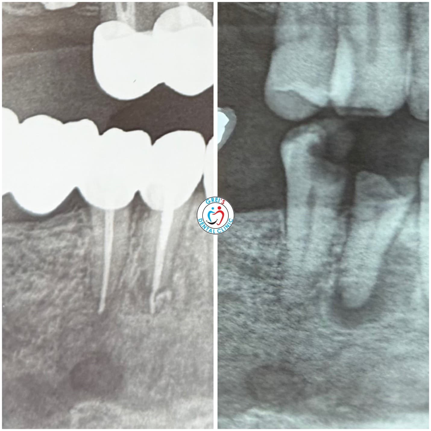 Endodontic root canal therapy