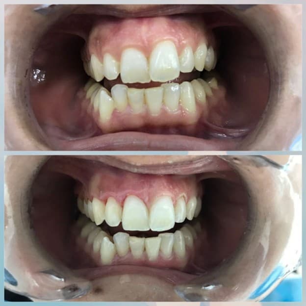 Gingivectomy procedure and gum line reshaping