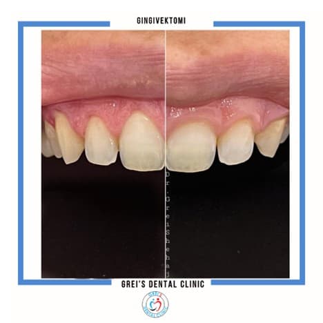 Gingivectomy procedure and gum line reshaping