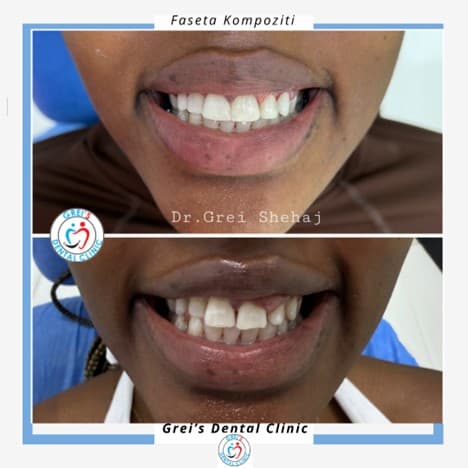 Gingivectomy procedure and gum line reshaping