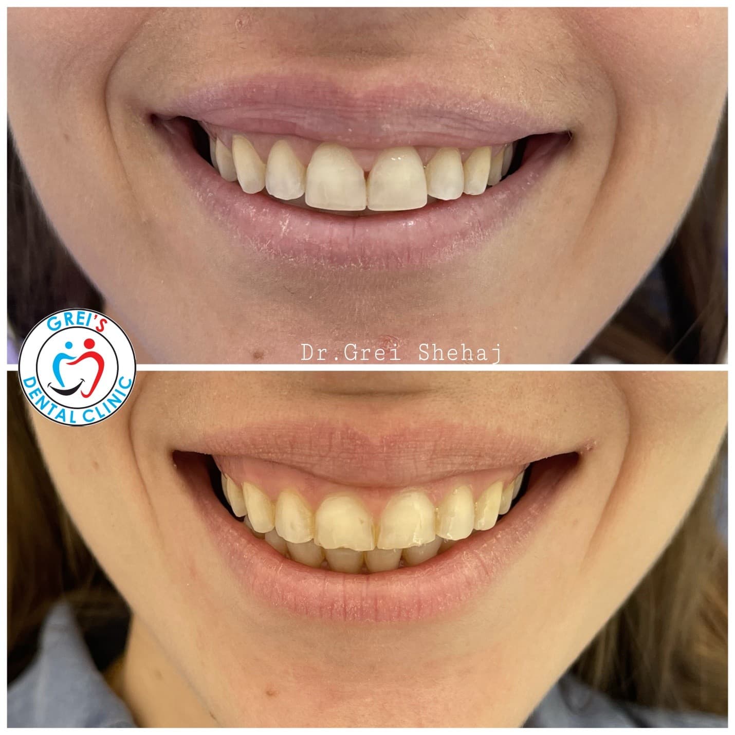 Gingivectomy procedure and gum line reshaping