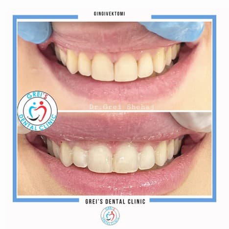Gingivectomy procedure and gum line reshaping