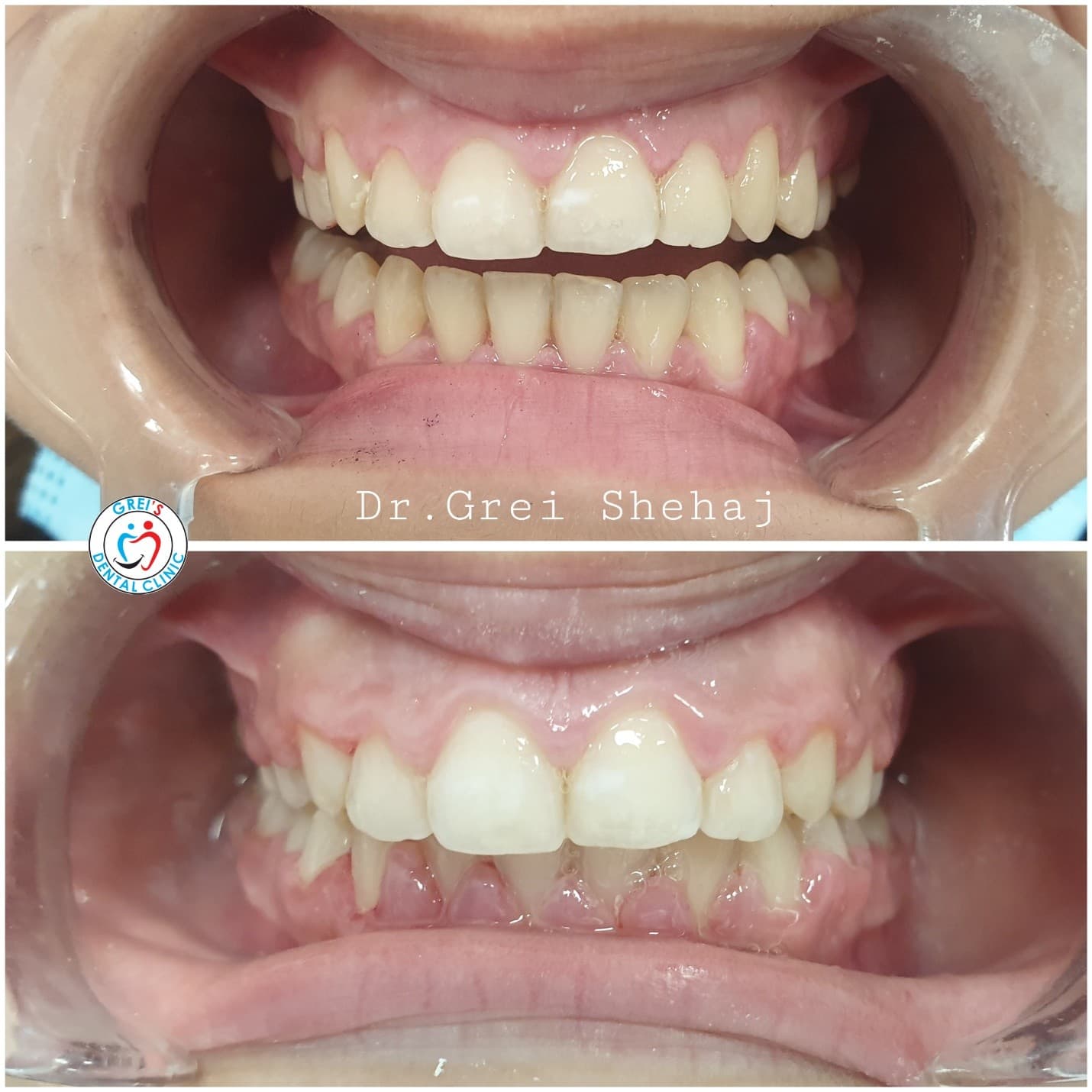 Gingivectomy procedure and gum line reshaping