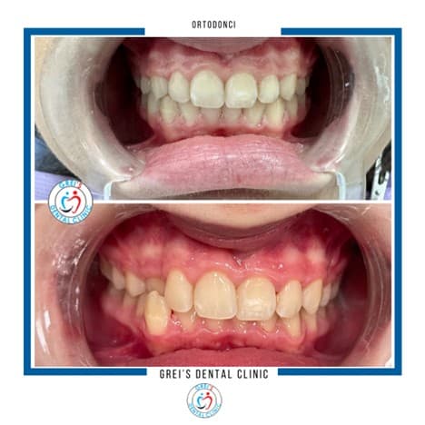 Orthodontic treatment progression and alignment