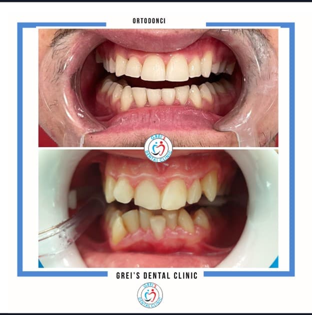 Orthodontic treatment progression and alignment