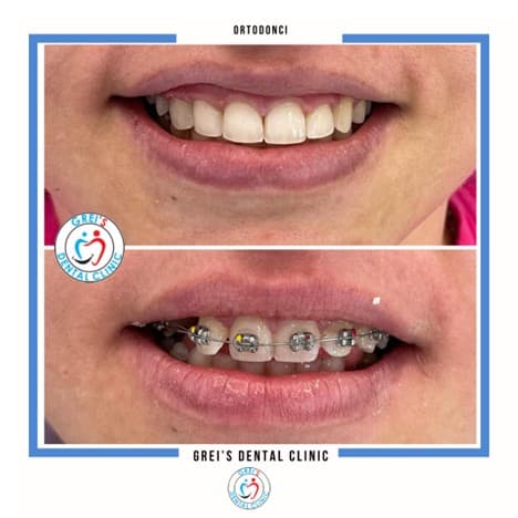 Orthodontic treatment progression and alignment