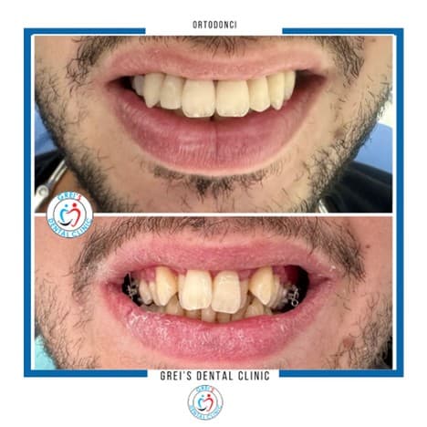 Orthodontic treatment progression and alignment
