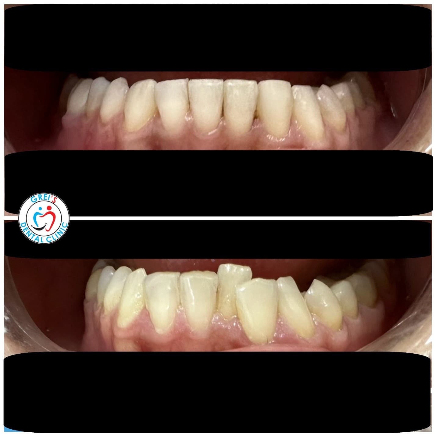Orthodontic treatment progression and alignment