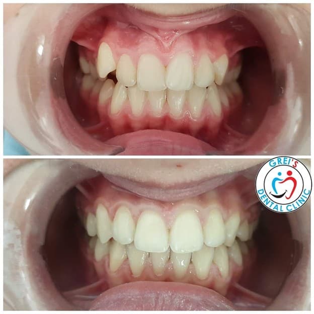 Orthodontic treatment progression and alignment