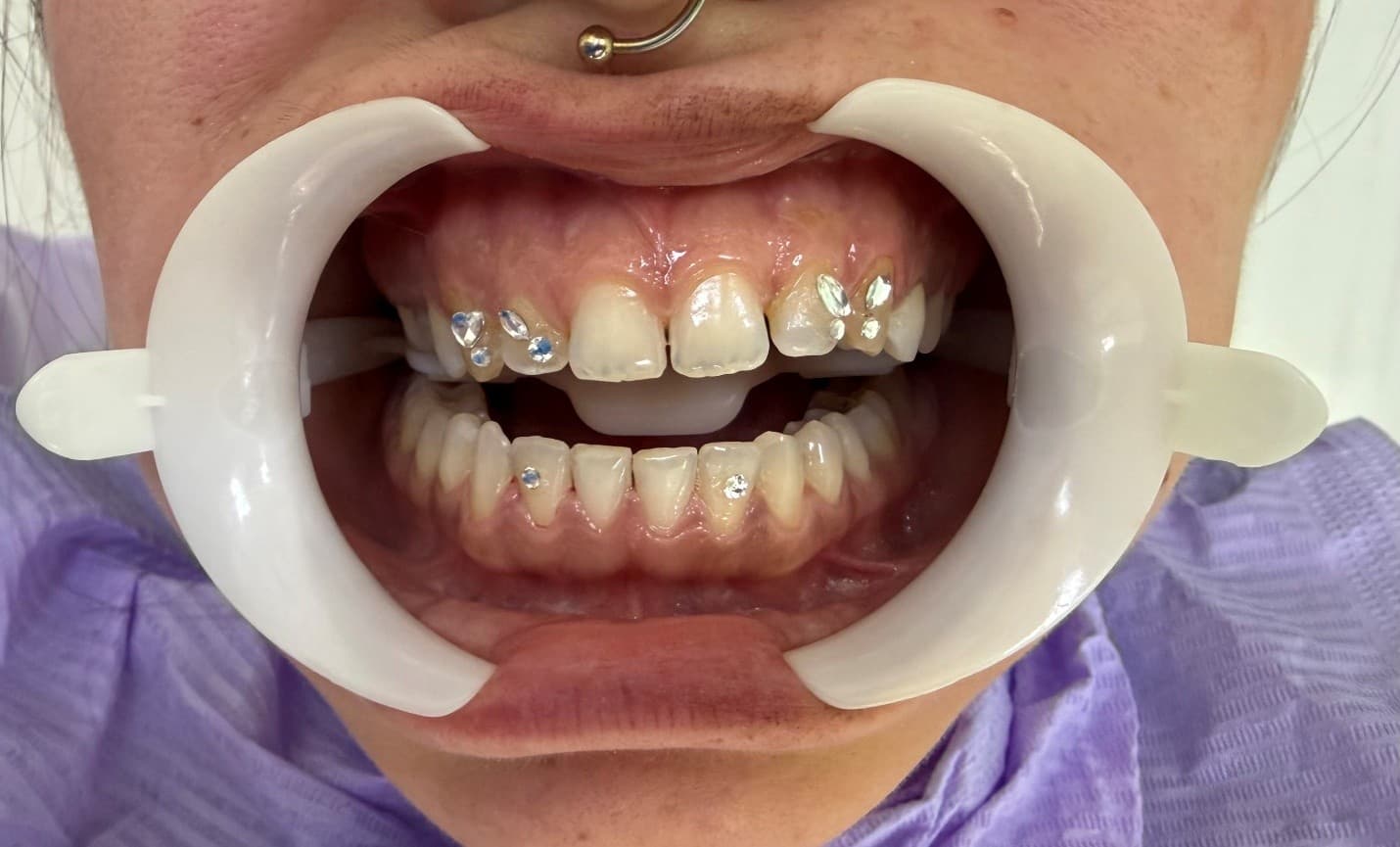 Tooth piercing and dental gem application