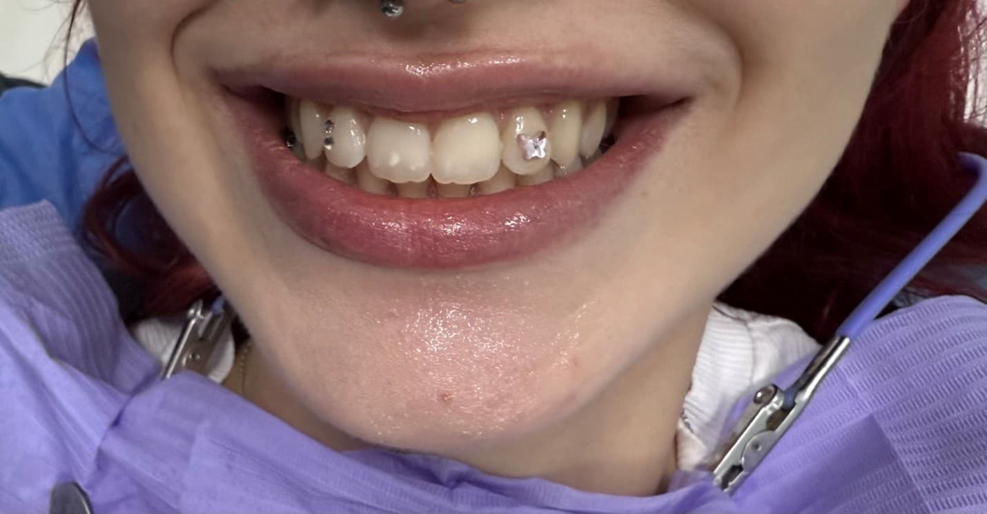 Tooth piercing and dental gem application
