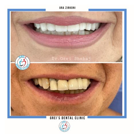 Zirconia bridge restoration