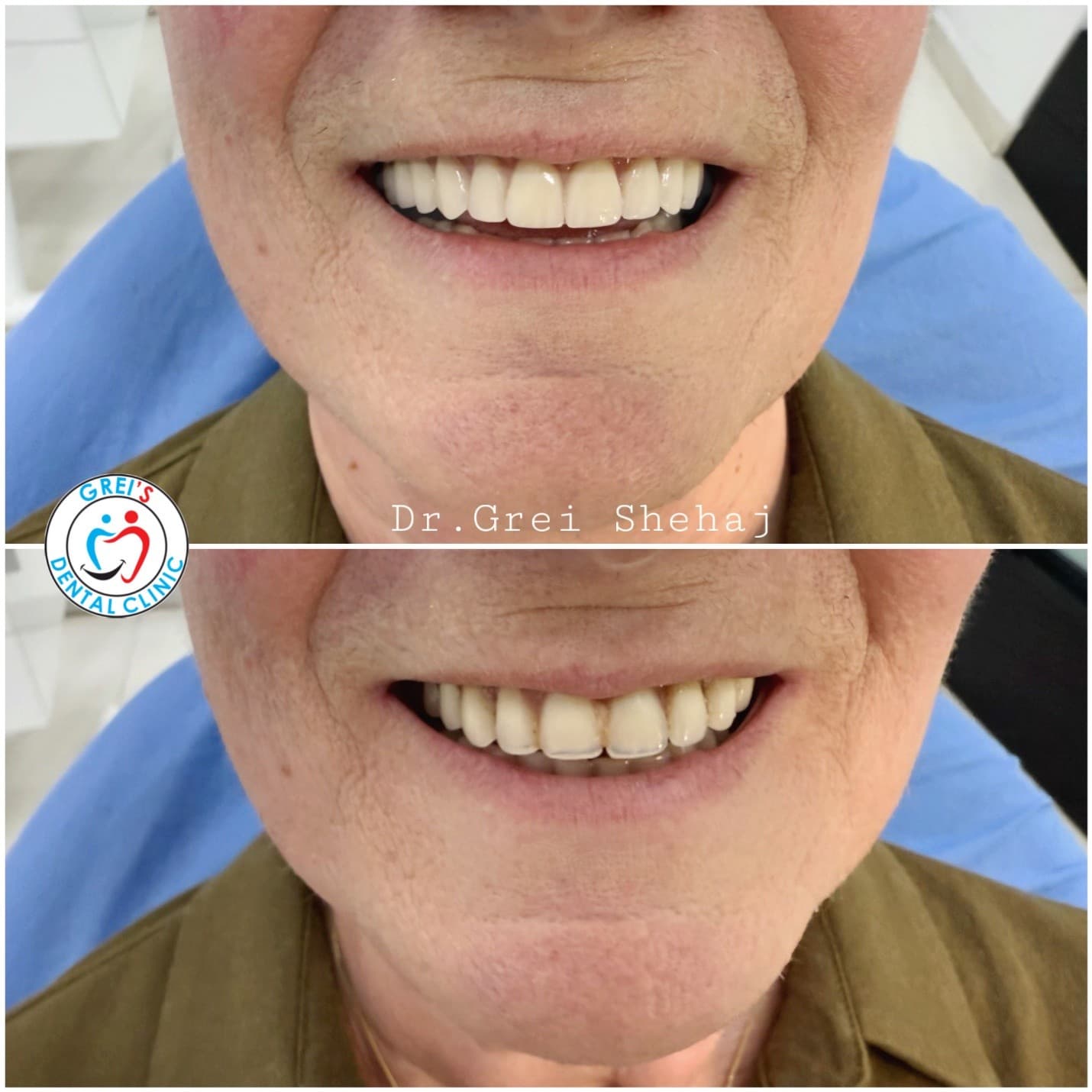 Prosthetic restoration