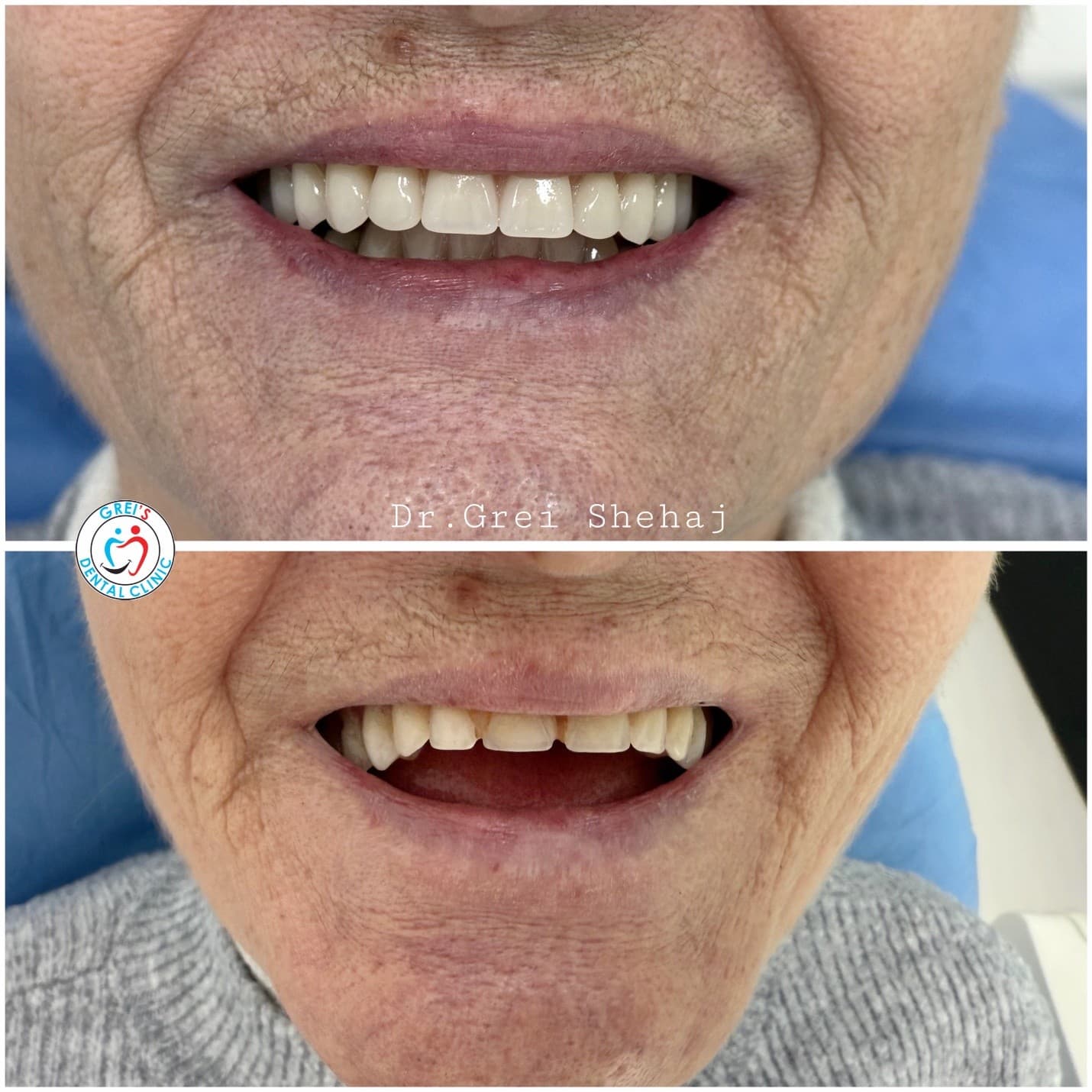 Prosthetic restoration