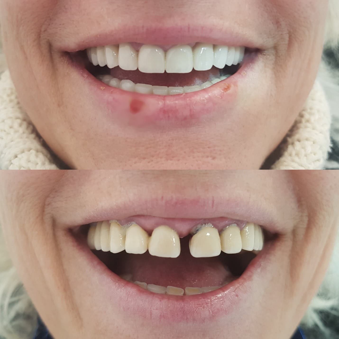 Prosthetic restoration