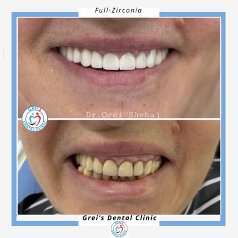Full zirconia restoration
