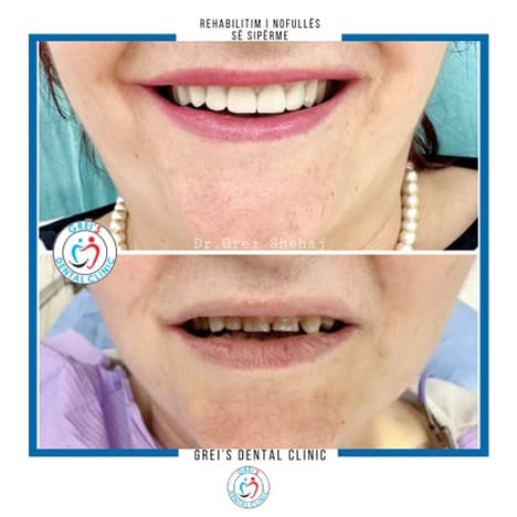 Upper jaw rehabilitation