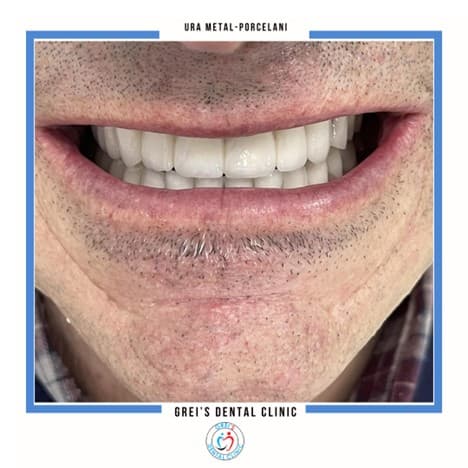 Metal-ceramic bridge