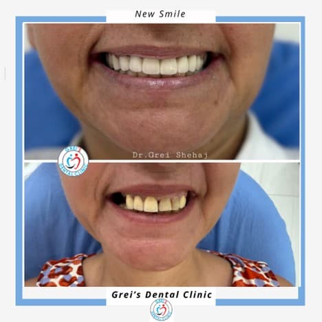 Prosthetic restoration