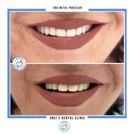 Metal-ceramic bridge