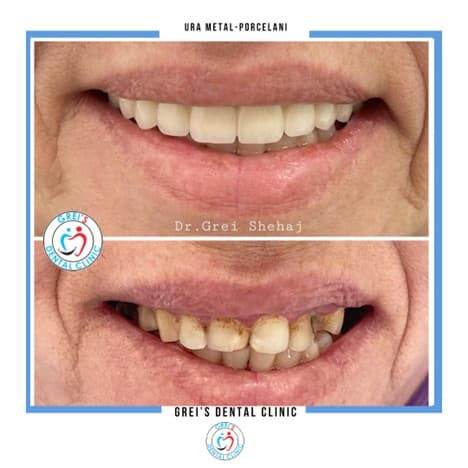 Metal-ceramic bridge