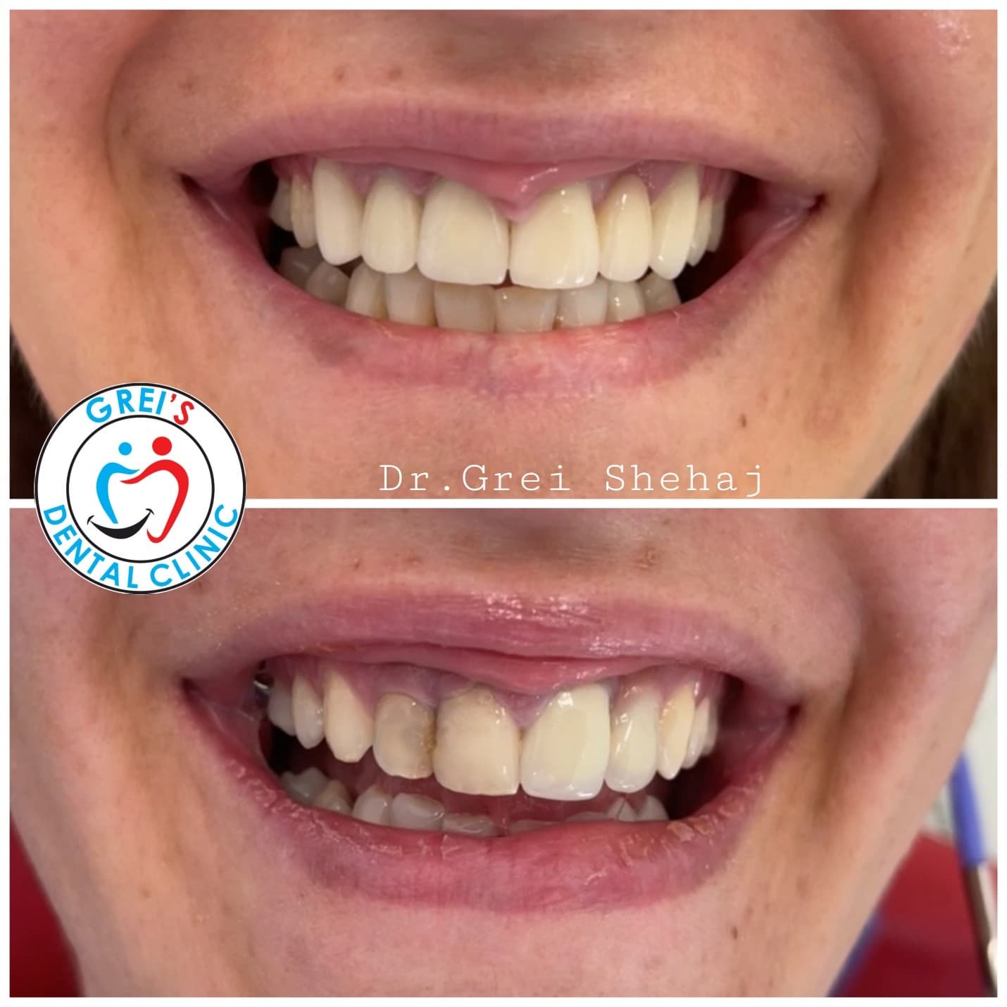 Prosthetic restoration