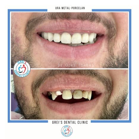 Metal-ceramic bridge