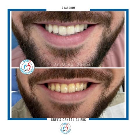 Professional in-clinic whitening