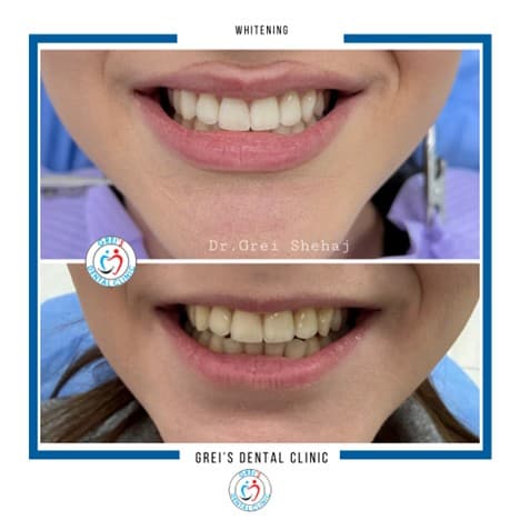 Professional in-clinic whitening