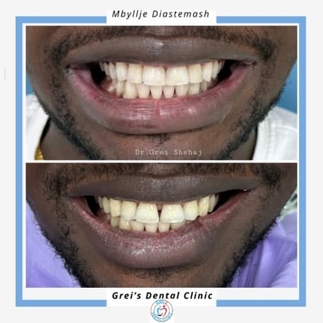 Whitening and diastema closure