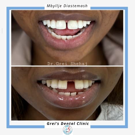 Whitening and diastema closure