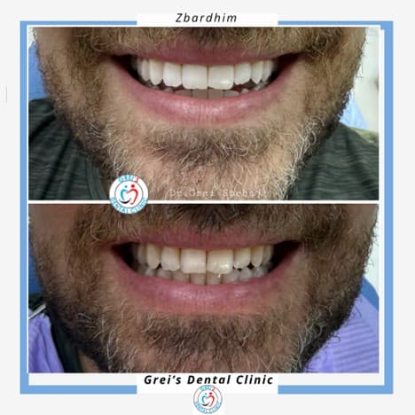 Professional in-clinic whitening