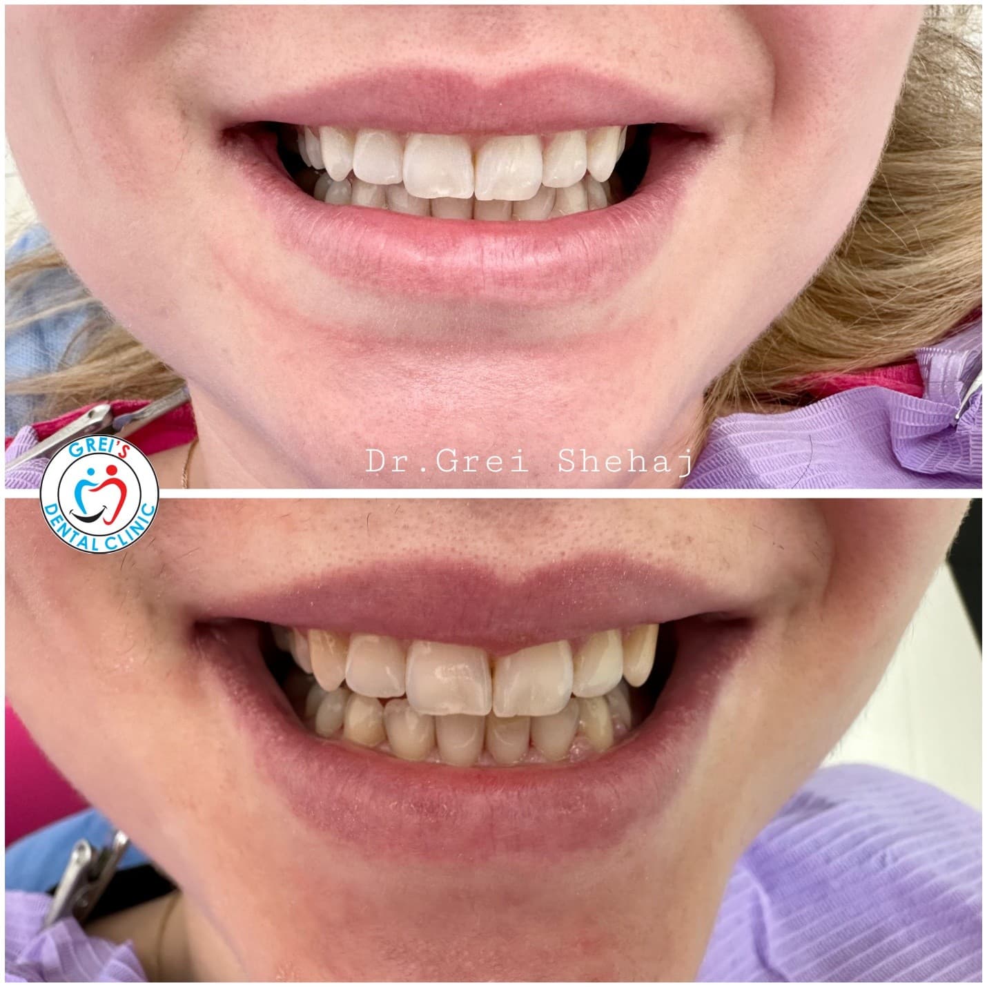 Professional in-clinic whitening