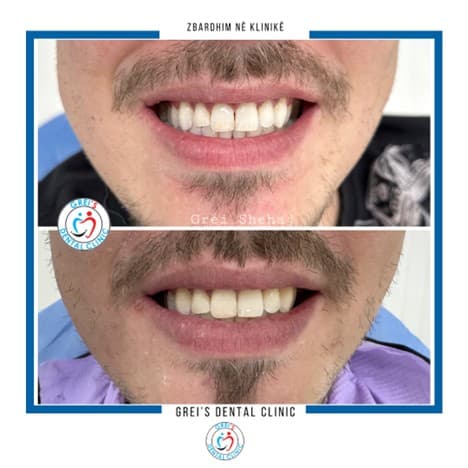 Professional in-clinic whitening