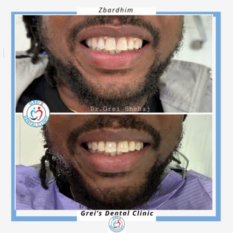 Professional in-clinic whitening